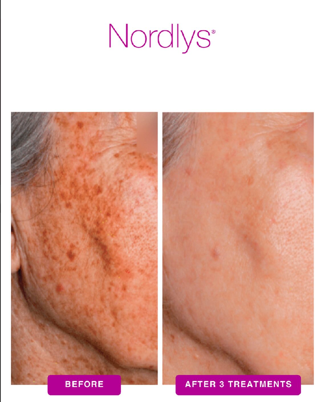 Nordlys logo with before-and-after photos showing skin texture improvement on cheek and jawline area after laser skin resurfacing treatment